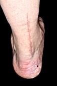 Scar from Achilles tendon surgery