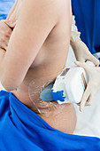 CoolSculpting, cryolipolysis session