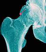 Hip osteoarthritis, coloured X-ray