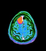 Meningioma brain tumour, MRI