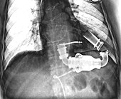 Ventricular assist device, X-ray