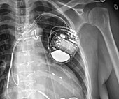 Pacemaker, X-ray