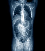 Normal colon, CT scan