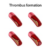 Thrombus formation, illustration