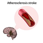 Atherosclerosis stroke, illustration