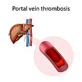Portal vein thrombosis, illustration