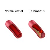 Thrombosis and normal blood vessel, illustration