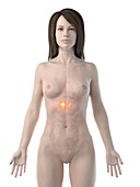Adrenal cancer, conceptual computer illustration