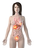 Cancer metastasis, conceptual computer illustration