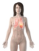 Lung cancer, conceptual computer illustration