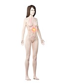 Stomach cancer, conceptual computer illustration