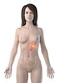 Stomach cancer, conceptual computer illustration