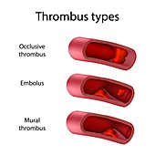 Thrombus types, illustration
