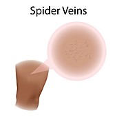 Spider veins, illustration