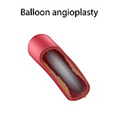Balloon angioplasty, illustration