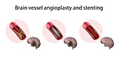 Brain vessel angioplasty and stenting, illustration