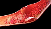 Blood clot inside a vein, illustration