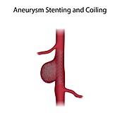 Aneurysm stenting and coiling, illustration