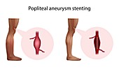 Popliteal aneurysm stenting, illustration