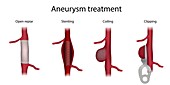 Aneurysm treatment, illustration