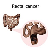 Rectal cancer, illustration
