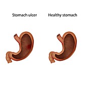 Stomach ulcer and healthy stomach, illustration