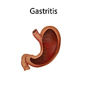 Gastritis, illustration