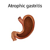 Atrophic gastritis, illustration