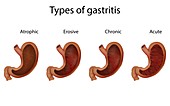 Types of gastritis, illustration