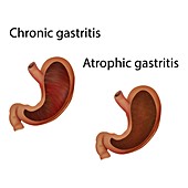 Chronic and atrophic gastritis, illustration