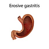 Erosive gastritis, illustration