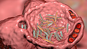 Bacterial pneumonia, illustration