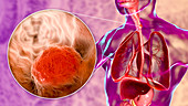 Oesophageal cancer, composite illustration