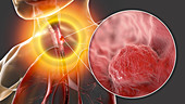 Oesophageal cancer, composite illustration