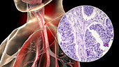 Oesophageal cancer, illustration and micrograph