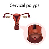 Cervical polyps, illustration