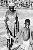 Onchocerciasis blindness in Mali