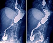 Cancer of the oesophagus,X-rays