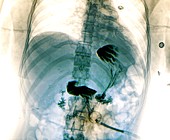 Feeding tube in motor neurone disease,X-ray