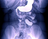 Stomach in bariatric surgery,X-ray
