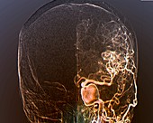 Brain aneurysm,angiogram
