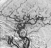 Brain aneurysm,angiogram