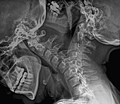 Flexion of the cervical spine,X-rays