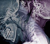 Flexion of the cervical spine,X-rays