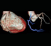 Coronary artery evaluation,3D CT angiography