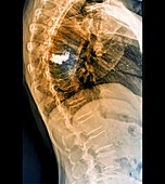 Osteoporosis of the spine with vertebroplasty,X-ray