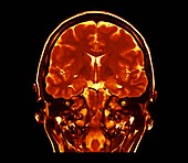Human brain,coronal MRI scan