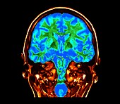 Human brain,coronal MRI scan