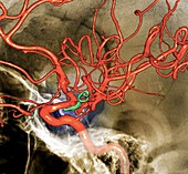 Cerebral aneurysm treatment,3D CT angiogram