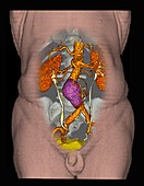 Aortic aneurysm near kidneys,3D CT scan